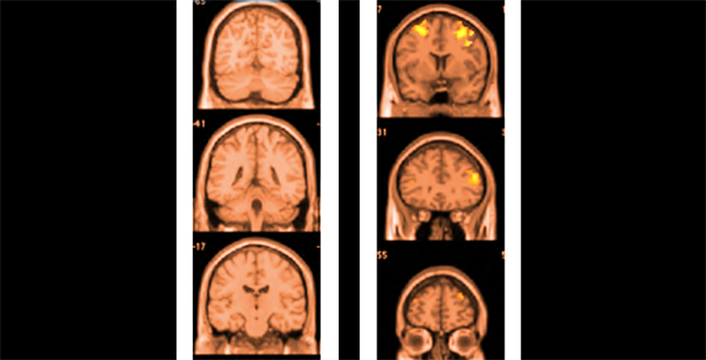 various brain scans